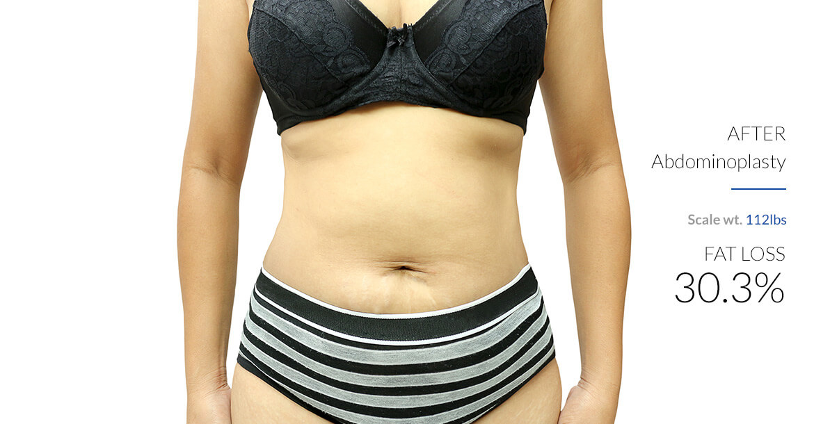 After-Abdominoplasty