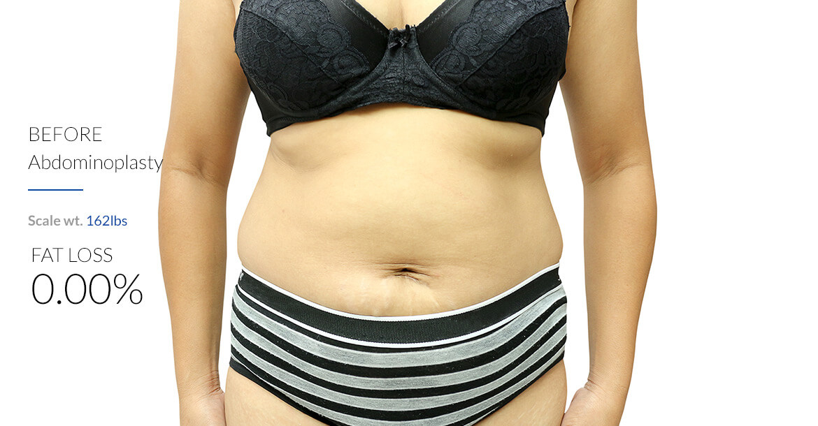 Before-Abdominoplasty